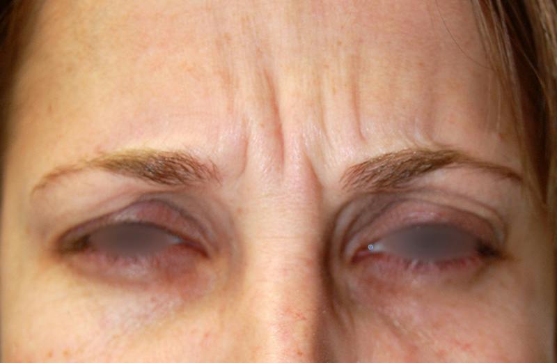 Botox Before & After Gallery - Patient 349416 - Image 1