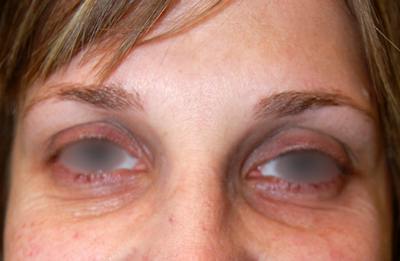 Botox Before & After Gallery - Patient 349416 - Image 2
