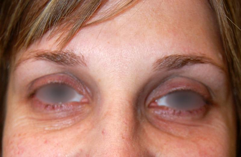 Botox Before & After Gallery - Patient 349416 - Image 2