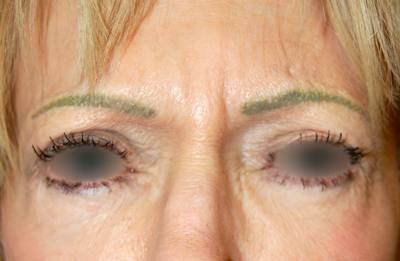 Botox Before & After Gallery - Patient 874753 - Image 1