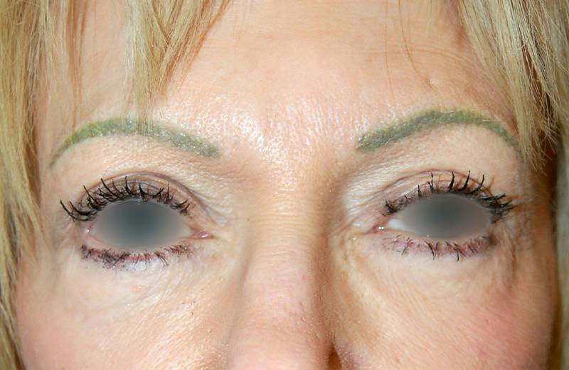 Botox Before & After Gallery - Patient 874753 - Image 2