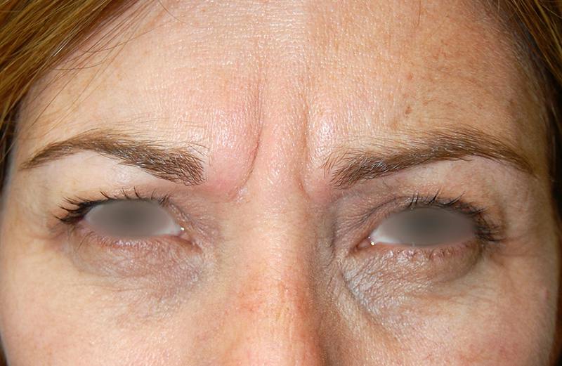 Botox Before & After Gallery - Patient 928024 - Image 1