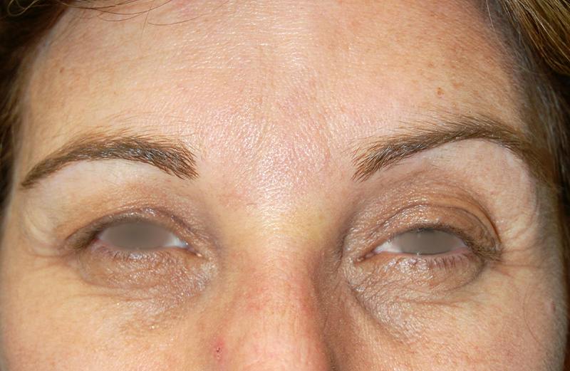 Botox Before & After Gallery - Patient 928024 - Image 2