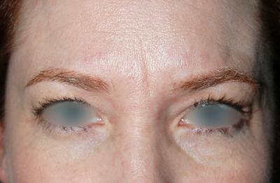 Botox Before & After Gallery - Patient 421058 - Image 1