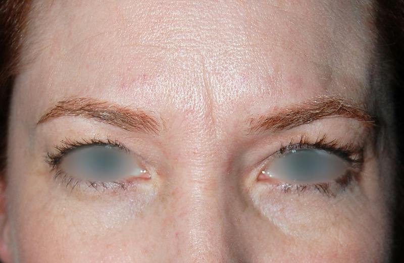 Botox Before & After Gallery - Patient 421058 - Image 1