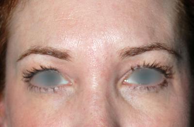Botox Before & After Gallery - Patient 421058 - Image 2