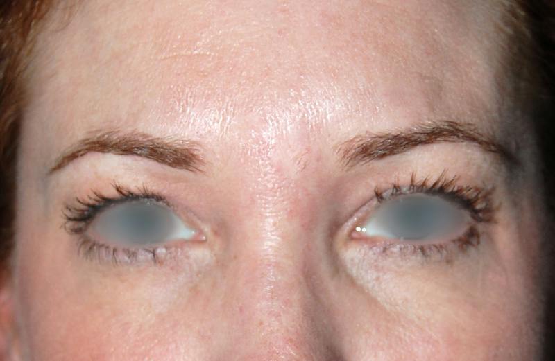 Botox Before & After Gallery - Patient 421058 - Image 2