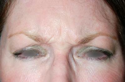 Botox Before & After Gallery - Patient 378077 - Image 1