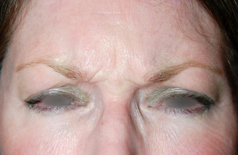 Botox Before & After Gallery - Patient 378077 - Image 1
