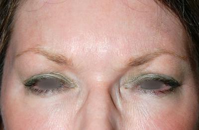 Botox Before & After Gallery - Patient 378077 - Image 2