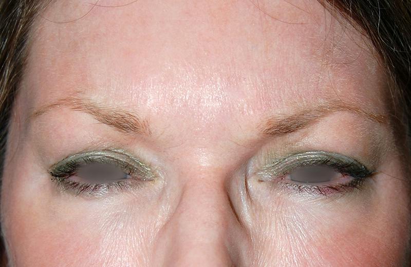 Botox Before & After Gallery - Patient 378077 - Image 2