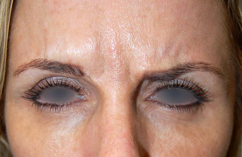 Botox Before & After Gallery - Patient 193887 - Image 2