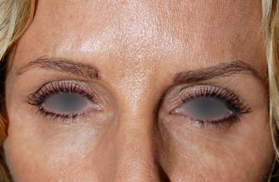 Botox Before & After Gallery - Patient 193887 - Image 1