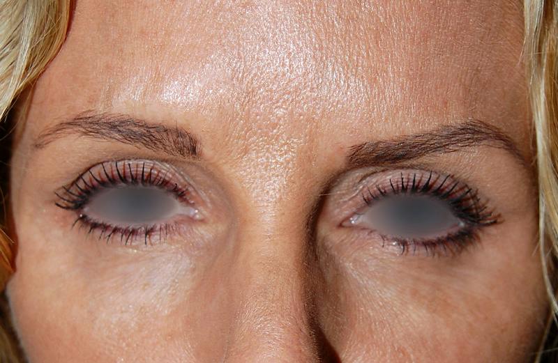 Botox Before & After Gallery - Patient 193887 - Image 1