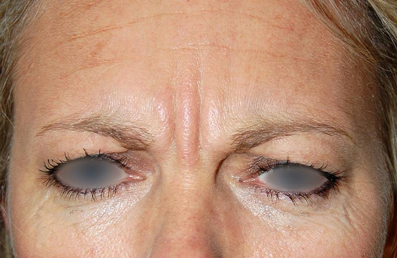 Botox Before & After Gallery - Patient 188698 - Image 1