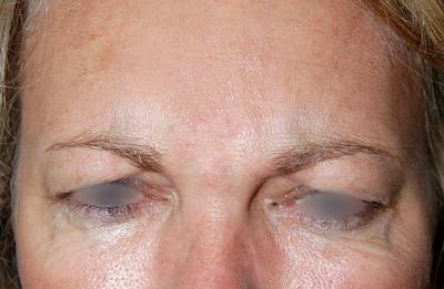 Botox Before & After Gallery - Patient 188698 - Image 2