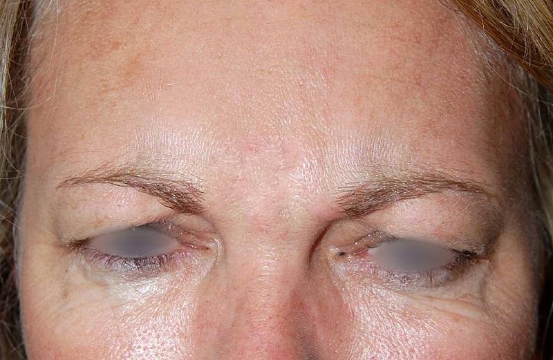 Botox Before & After Gallery - Patient 188698 - Image 2