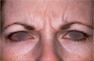 Botox Before & After Gallery - Patient 174126 - Image 1