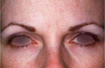 Botox Before & After Gallery - Patient 174126 - Image 2