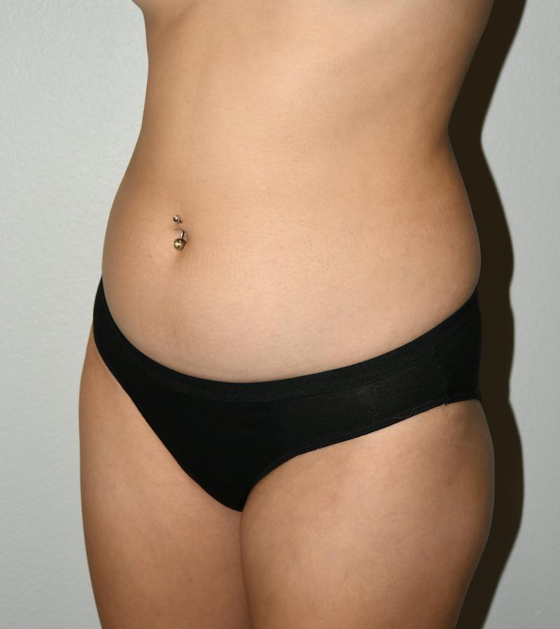 Liposuction Before & After Gallery - Patient 146046 - Image 5