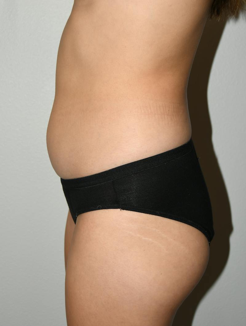 Liposuction Before & After Gallery - Patient 146046 - Image 7
