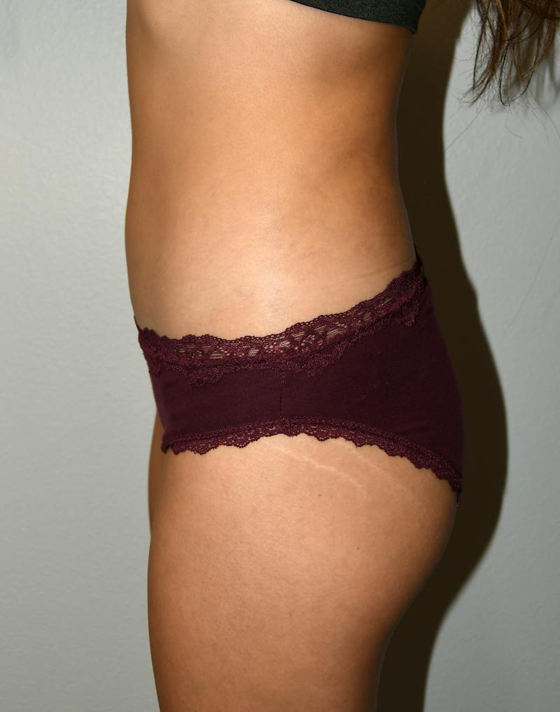 Liposuction Before & After Gallery - Patient 146046 - Image 8