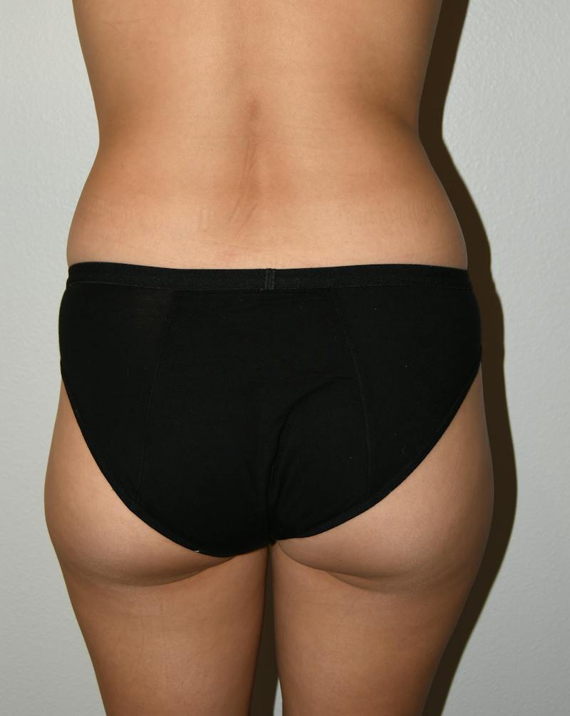 Liposuction Before & After Gallery - Patient 146046 - Image 3