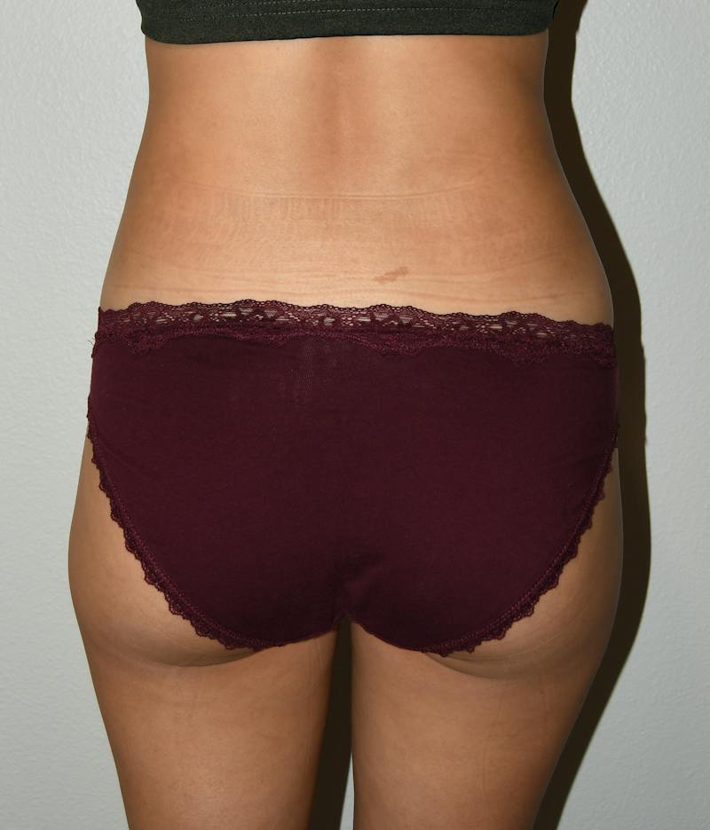 Liposuction Before & After Gallery - Patient 146046 - Image 4