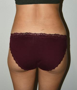 Liposuction Before & After Gallery - Patient 146046 - Image 4