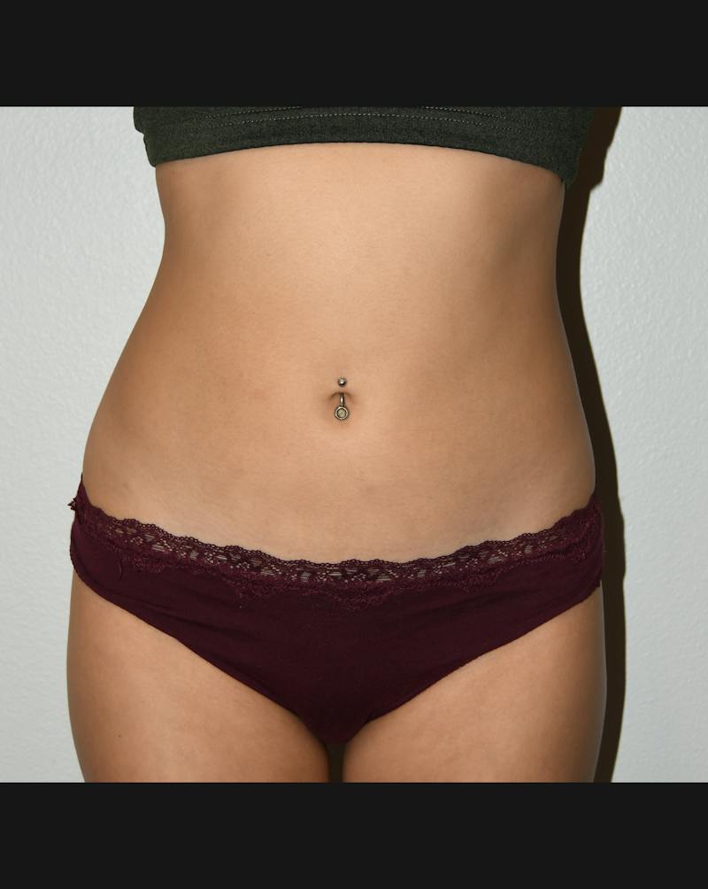 Liposuction Before & After Gallery - Patient 146046 - Image 2