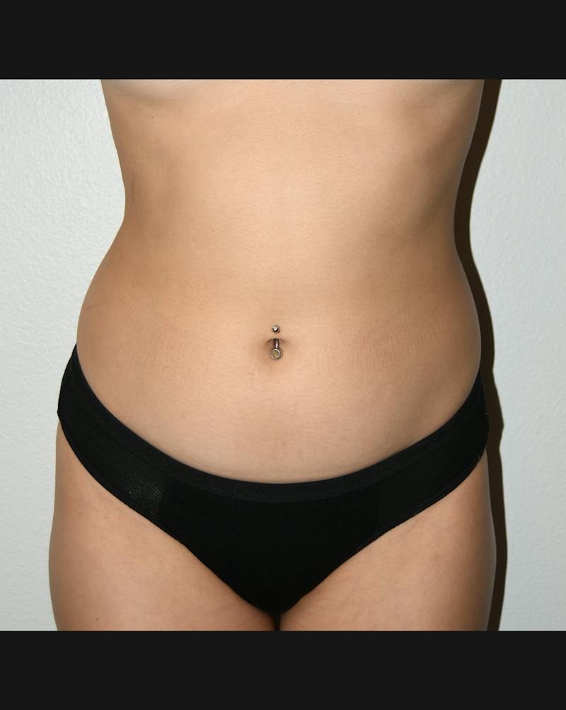 Liposuction Before & After Gallery - Patient 146046 - Image 1