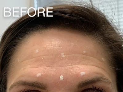Botox/Dysport Before & After Gallery - Patient 380386 - Image 1