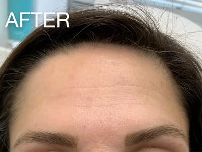 Botox/Dysport Before & After Gallery - Patient 380386 - Image 2