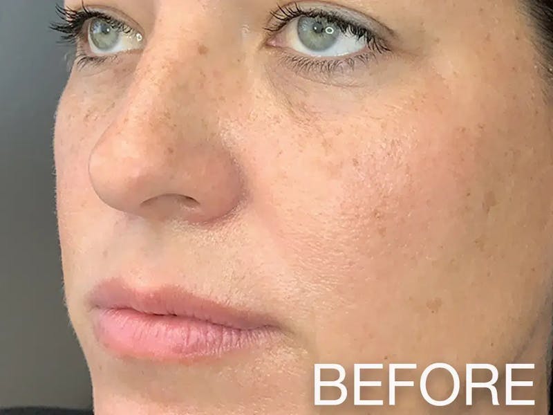 Cheek Filler Before & After Gallery - Patient 262712 - Image 1