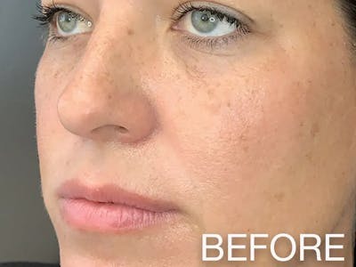 Cheek Filler Before & After Gallery - Patient 262712 - Image 1