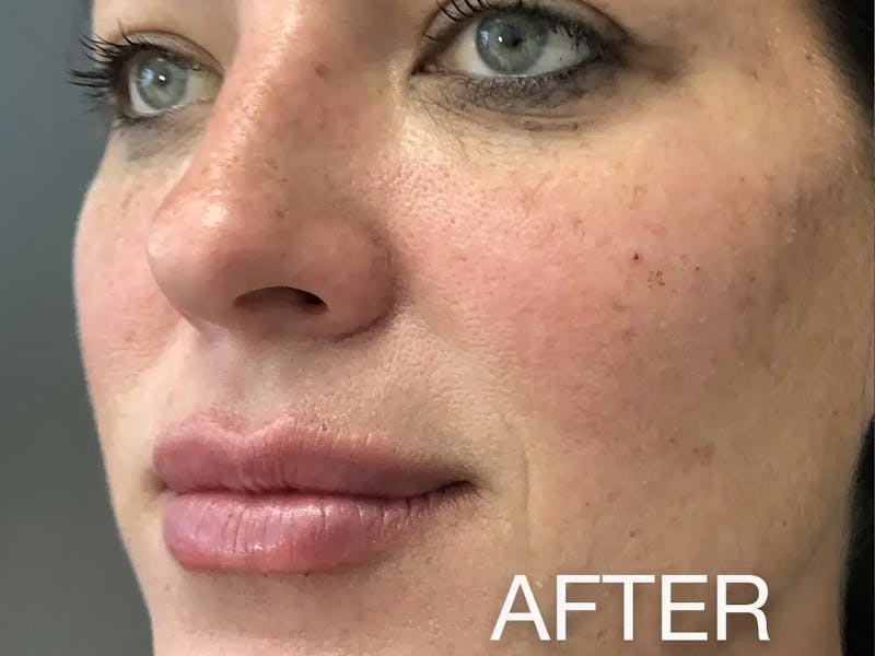 Cheek Filler Before & After Gallery - Patient 262712 - Image 2