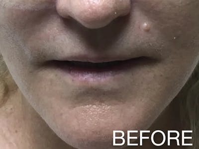 Lip Filler Before & After Gallery - Patient 320496 - Image 1