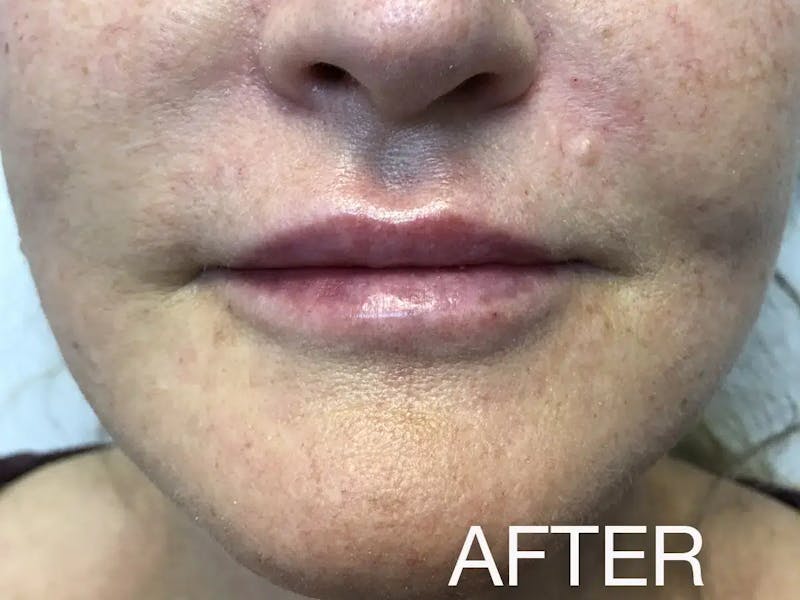 Lip Filler Before & After Gallery - Patient 415545 - Image 2