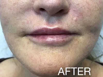 Lip Filler Before & After Gallery - Patient 320496 - Image 2