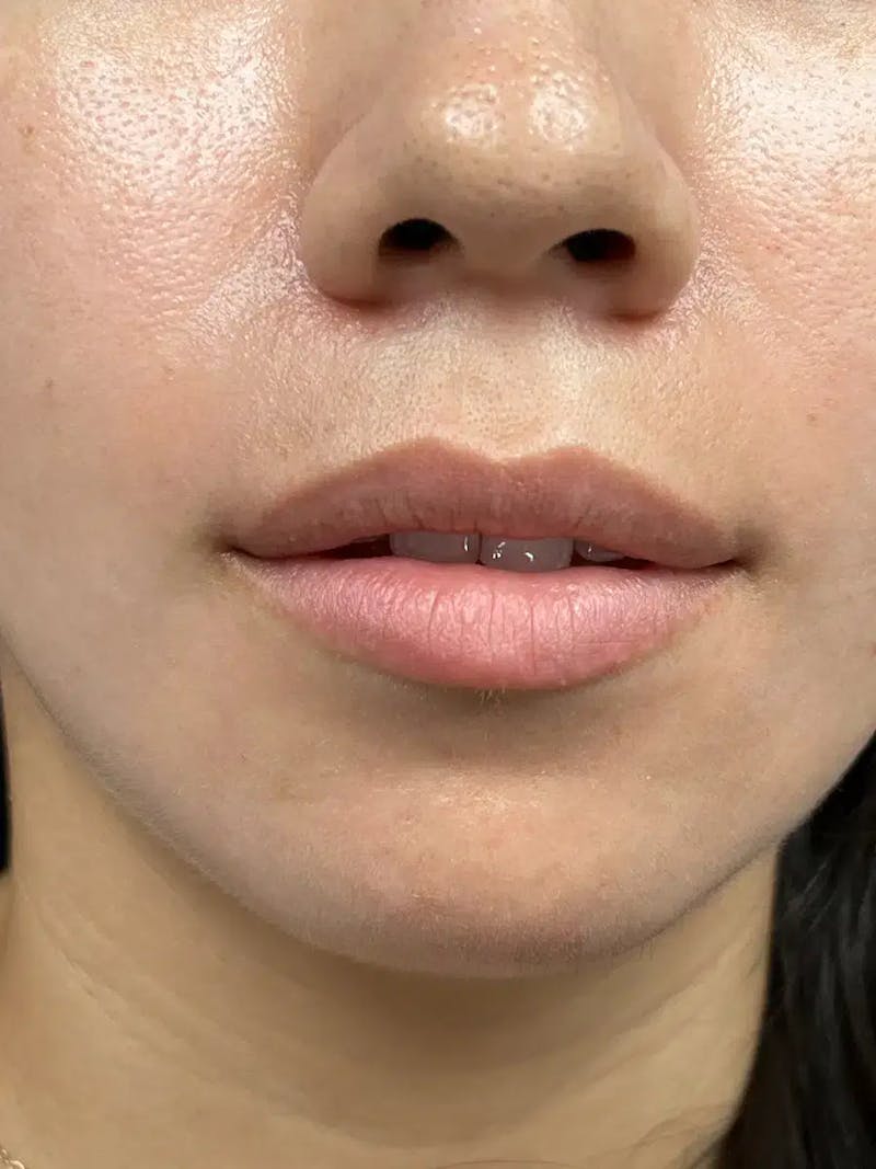 Lip Filler Before & After Gallery - Patient 357808 - Image 1