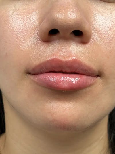 Lip Filler Before & After Gallery - Patient 357808 - Image 2