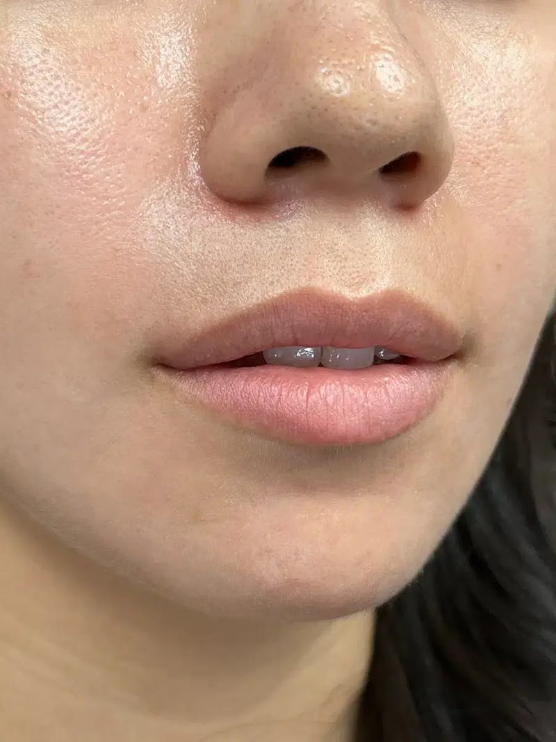 Lip Filler Before & After Gallery - Patient 357808 - Image 3