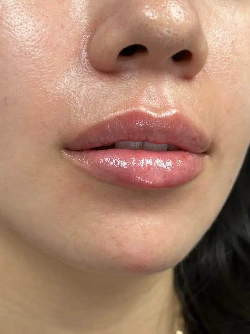 Lip Filler Before & After Gallery - Patient 357808 - Image 4