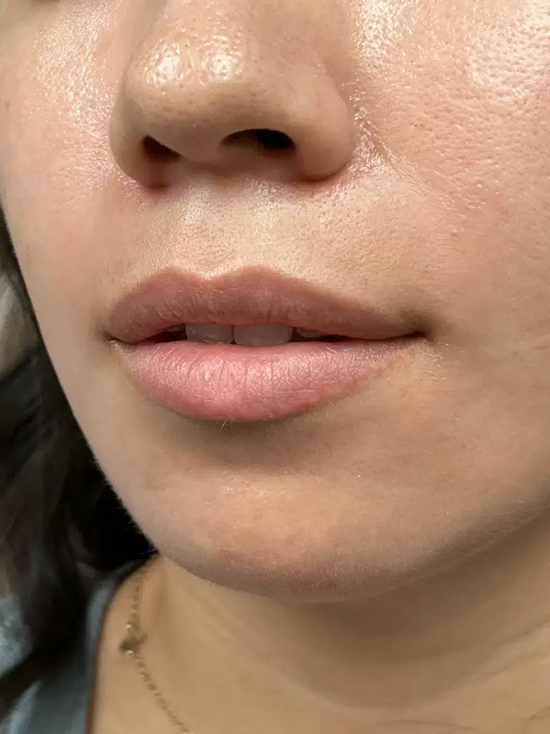 Lip Filler Before & After Gallery - Patient 357808 - Image 5