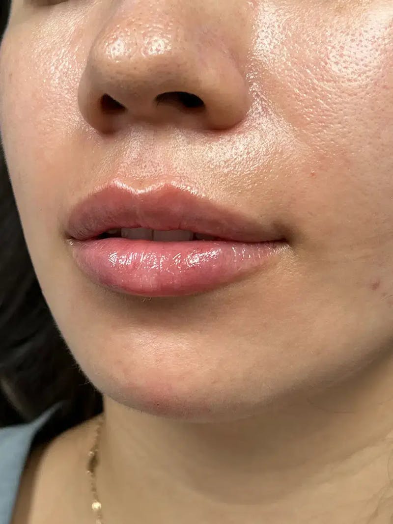 Lip Filler Before & After Gallery - Patient 357808 - Image 6