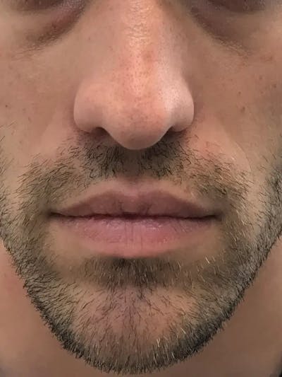 Lip Filler Before & After Gallery - Patient 257392 - Image 1