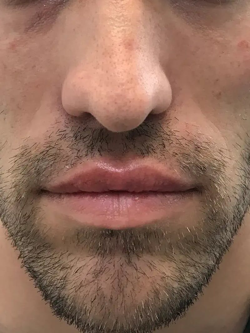 Lip Filler Before & After Gallery - Patient 863254 - Image 2