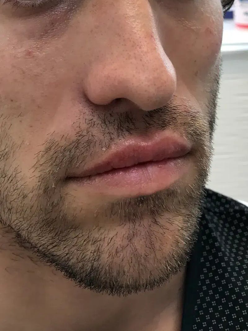 Lip Filler Before & After Gallery - Patient 863254 - Image 4