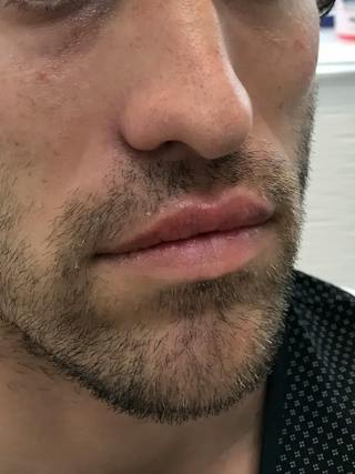 Lip Filler Before & After Gallery - Patient 863254 - Image 4