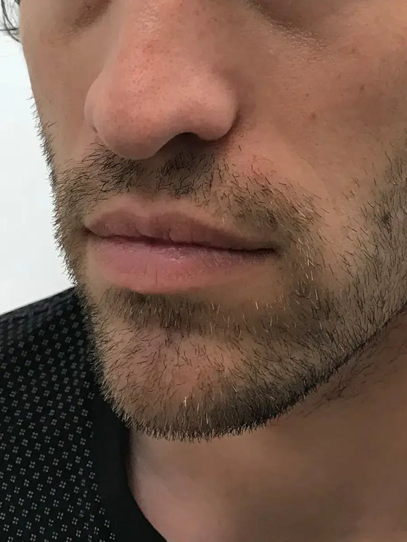 Lip Filler Before & After Gallery - Patient 863254 - Image 5